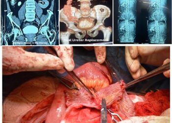 Groundbreaking Urological Surgery at SuperSpeciality Hospital, GMC Srinagar Saves Patient’s Kidneys