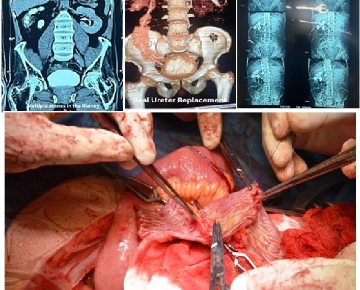 Groundbreaking Urological Surgery at SuperSpeciality Hospital, GMC Srinagar Saves Patient’s Kidneys