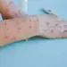 SKIMS on ‘alert’ for Mpox, set to ramp up testing