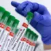 Suspected Mpox case under investigation; patient put under isolation, no cause for alarm