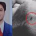 Kashmiri Doctor Performs Rare Brain Surgery, Saves 77-Year-Old Woman in Srinagar