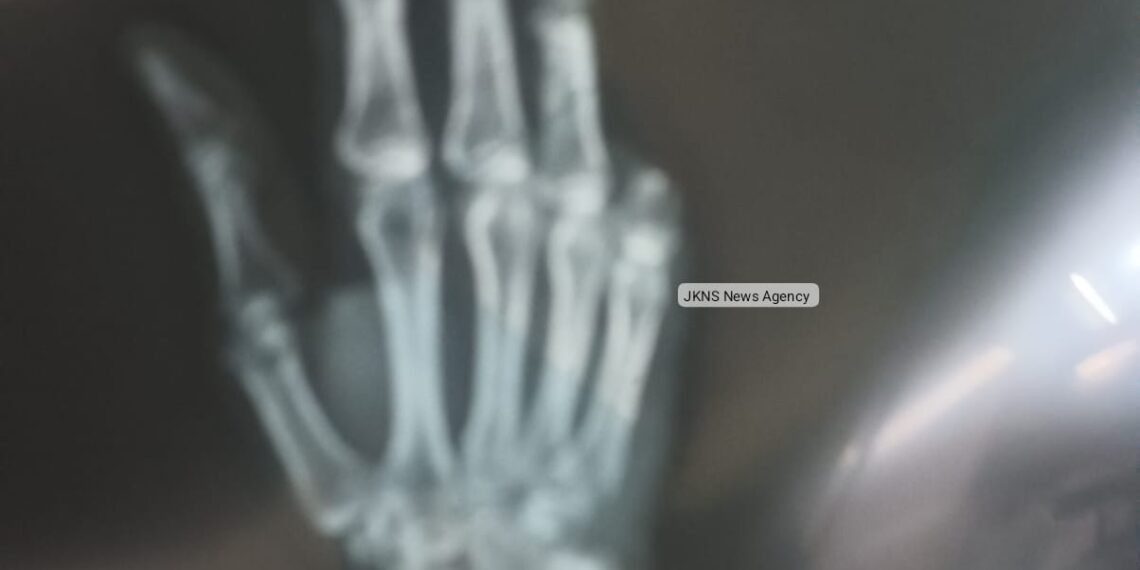 Dog Scare; Retired SP’s Pinky Finger Severed, Taken Away in Dog Attack at Lal Bazar
