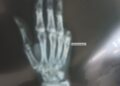 Dog Scare; Retired SP’s Pinky Finger Severed, Taken Away in Dog Attack at Lal Bazar