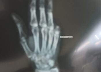 Dog Scare; Retired SP’s Pinky Finger Severed, Taken Away in Dog Attack at Lal Bazar