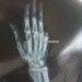Dog Scare; Retired SP’s Pinky Finger Severed, Taken Away in Dog Attack at Lal Bazar